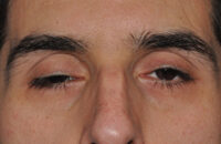 Droopy Upper Eyelids (Ptosis)