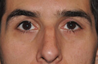 Droopy Upper Eyelids (Ptosis)