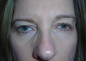 Droopy Upper Eyelids (Ptosis)