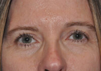 Droopy Upper Eyelids (Ptosis)