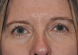 Droopy Upper Eyelids (Ptosis)