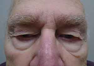 Droopy Upper Eyelids (Ptosis)