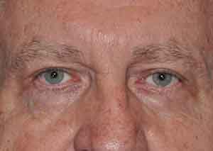 Droopy Upper Eyelids (Ptosis)