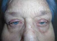 Droopy Upper Eyelids (Ptosis)