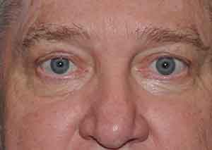 Droopy Upper Eyelids (Ptosis)