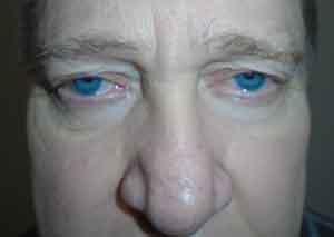 Droopy Upper Eyelids (Ptosis)