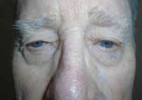 Droopy Upper Eyelids (Ptosis)