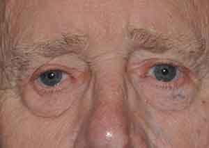 Droopy Upper Eyelids (Ptosis)