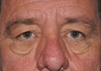 Lower Eyelid Lift or Blepharoplasty