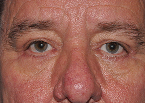 Lower Eyelid Lift or Blepharoplasty