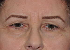 Eyebrow Lift or Forehead Lift