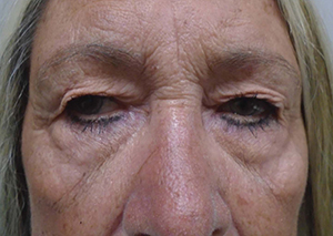 Droopy Upper Eyelids (Ptosis)