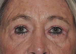 Droopy Upper Eyelids (Ptosis)