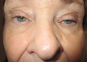 Droopy Upper Eyelids (Ptosis)