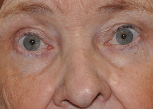 Droopy Upper Eyelids (Ptosis)