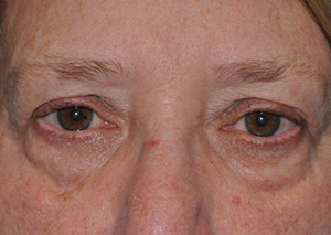 Droopy Upper Eyelids (Ptosis)