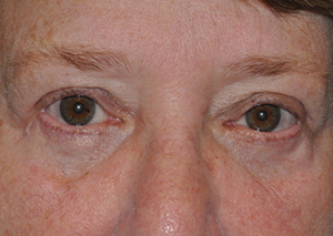 Droopy Upper Eyelids (Ptosis)