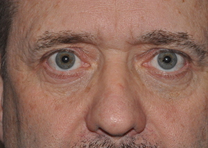 Lower Eyelid Lift or Blepharoplasty